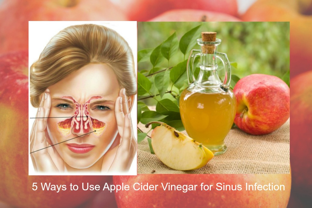 5 Ways to Use Apple Cider Vinegar for Sinus Infection 